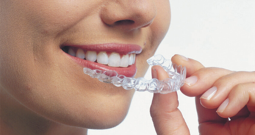 Braces-invisalign Braces-invisalign